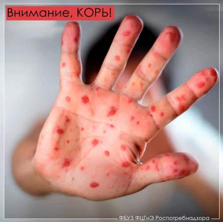 Внимание, КОРЬ!